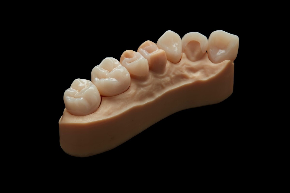 3D-printing-Permanent-restorations_2/Optimized_For_Web_JPEG-11022020_perm-crown