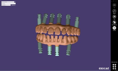 EXOCAD – Toronto bridge on implants