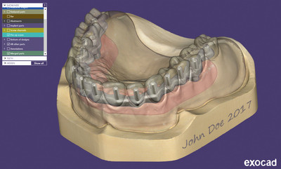 EXOCAD - Bar on implants