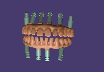 EXOCAD – Most na implantatima