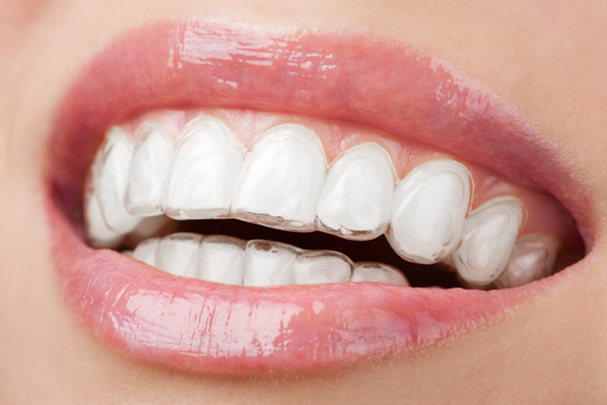 ortodontski-aparati/Smilelign-clear-braces