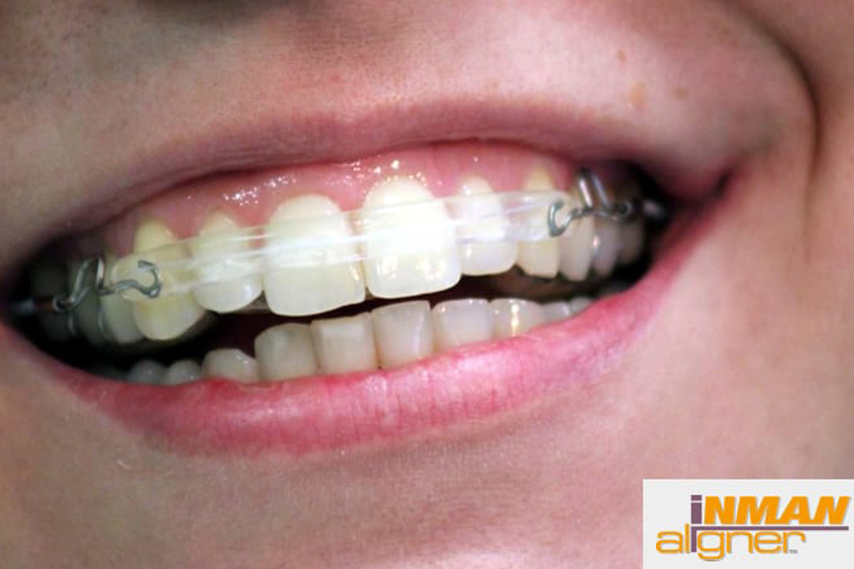 ortodontski-aparati_2/inman-aligner-pacient1